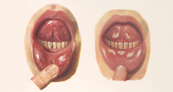 Venereal diseases - Syphilis